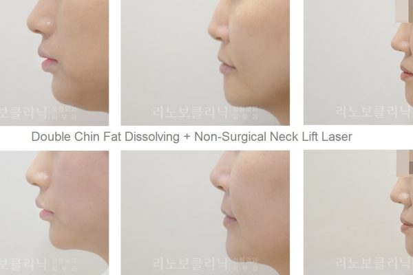 20 skin care before and after non surgical double chin fat dissolving and non surgical neck lift seoul guide medical