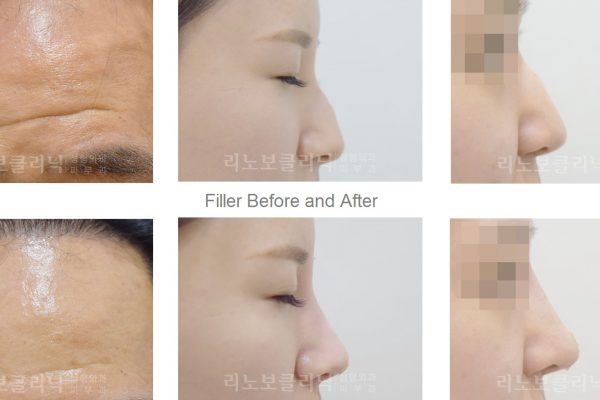 21 skin care before and after filler seoul guide medical