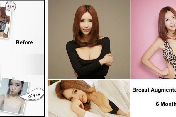 10 breast augmentation via implants before and after seoul guide medical