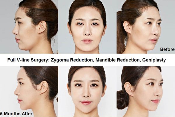 11 face contouring seoul guide medical before and after