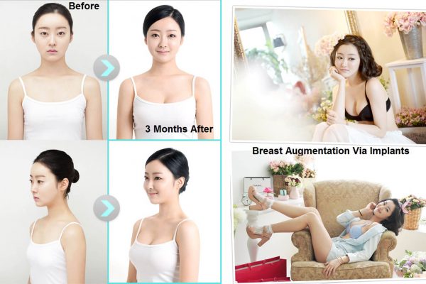 12 breast augmentation via implants before and after seoul guide medical