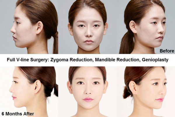 12 face contouring seoul guide medical before and after