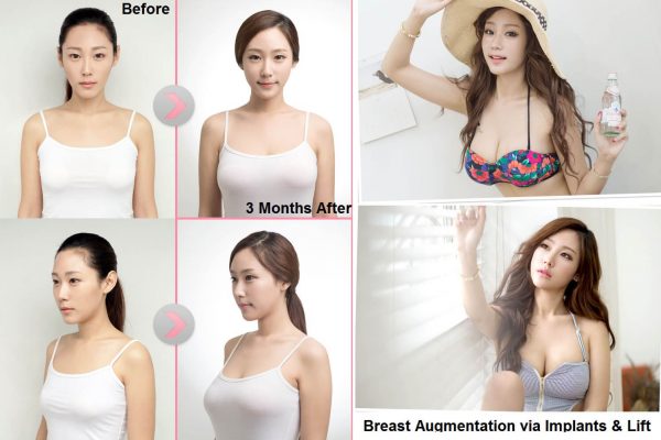 13 breast augmentation via implants and lift before and after seoul guide medical