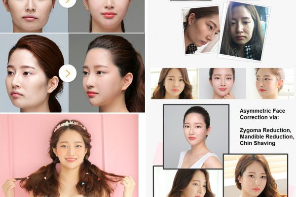 14 face contouring seoul guide medical before and after zygoma reduction, mandible reduction, chin shaving