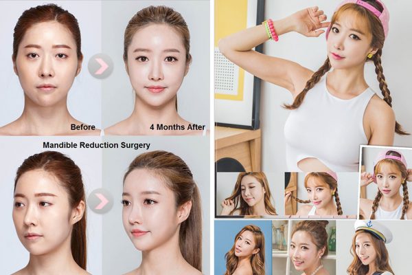 15 face contouring seoul guide medical before and after madible reduction surgery