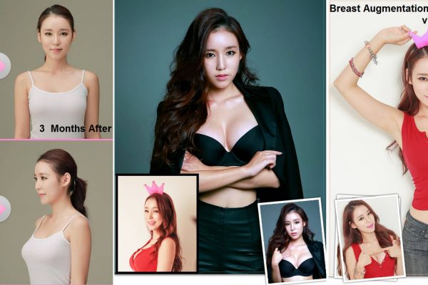 16 breast augmentation via implants before and after seoul guide medical
