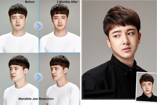 16 face contouring seoul guide medical before and after male madible reduction surgery