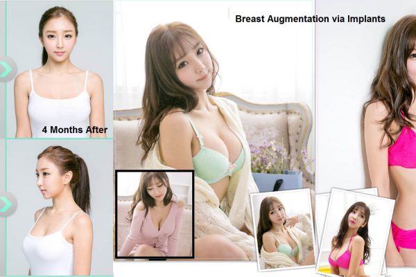 17 breast augmentation via implants before and after seoul guide medical