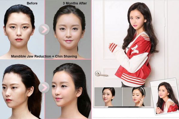 17 face contouring seoul guide medical before and after madible reduction surgery and chin shaving
