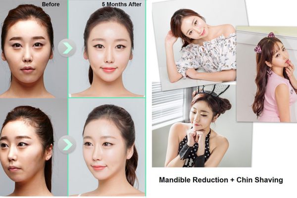 18 face contouring seoul guide medical before and after madible reduction surgery and chin shaving