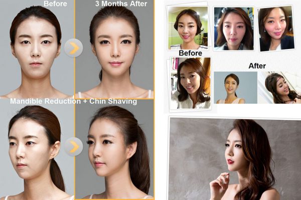 19 face contouring seoul guide medical before and after mandible reduction plus chin shaving