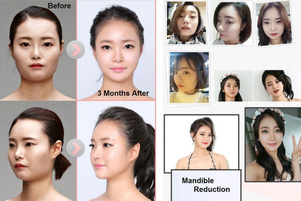 20 face contouring seoul guide medical before and after mandible reduction plus chin shaving