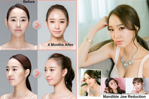 21 face contouring seoul guide medical before and after mandible reduction plus chin shaving