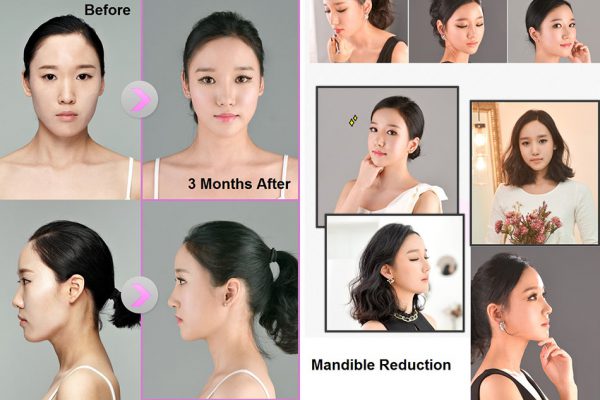 22 face contouring seoul guide medical before and after mandible reduction