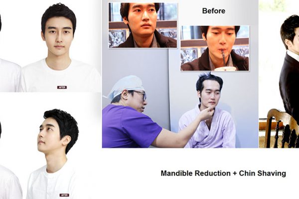 25 face contouring seoul guide medical before and after mandible reduction male plus chin shaving