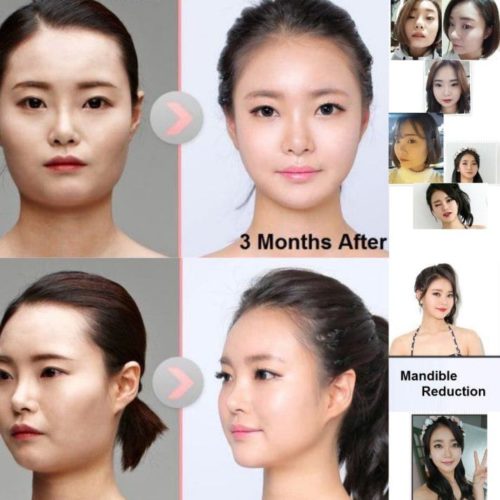 v line surgery korea before and after