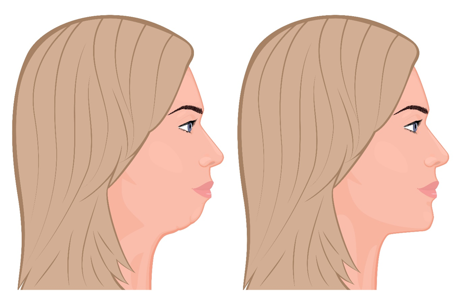 chin implant explain before and after