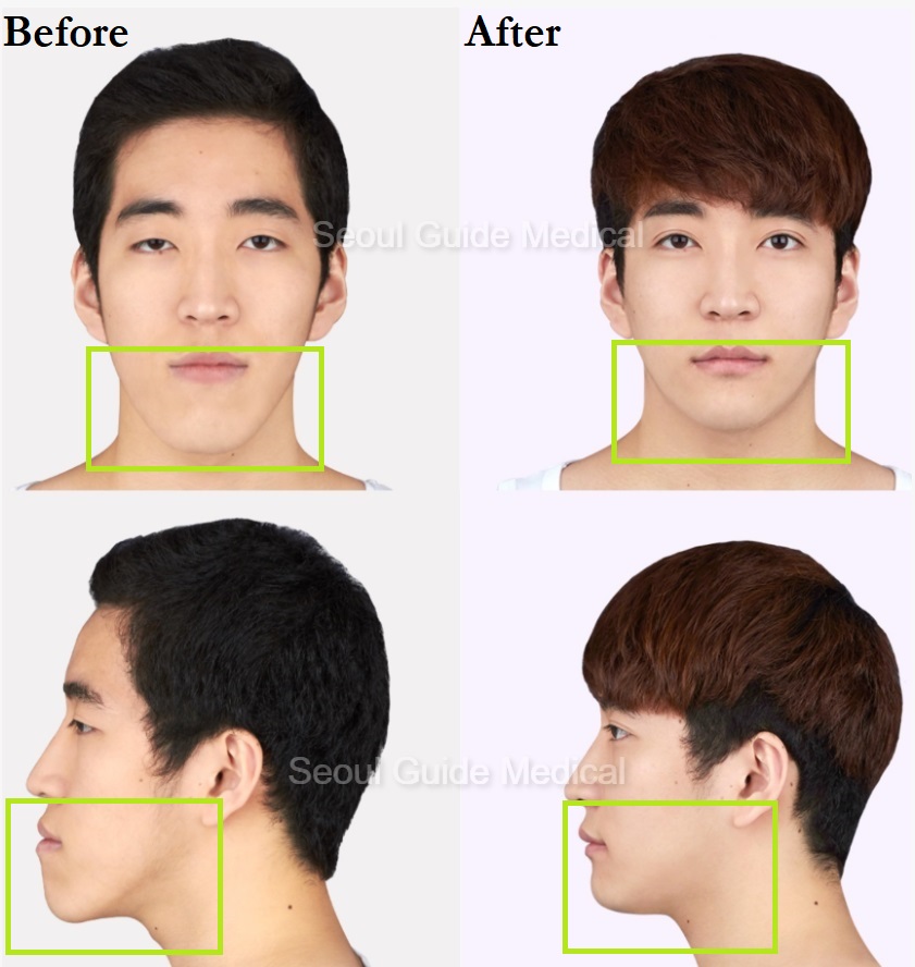 before-and-after-double-jaw-surgery-seoul-guide-medical